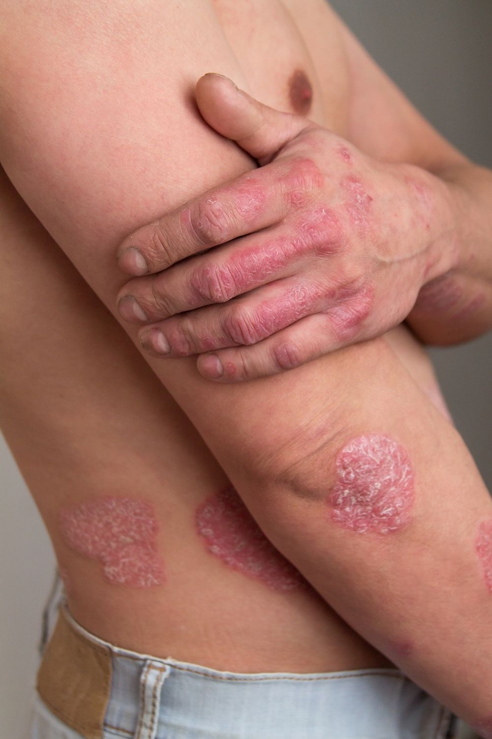 What is Psoriasis CHCW